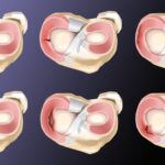 lesion-meniscal