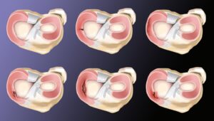 lesion-meniscal