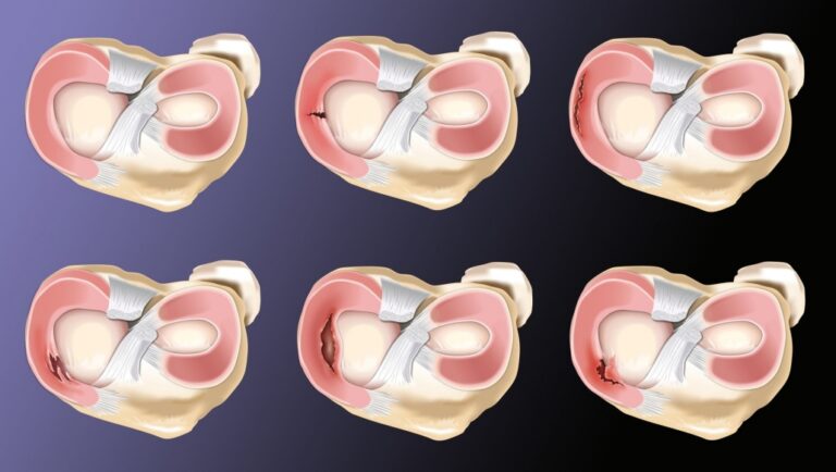 lesion-meniscal